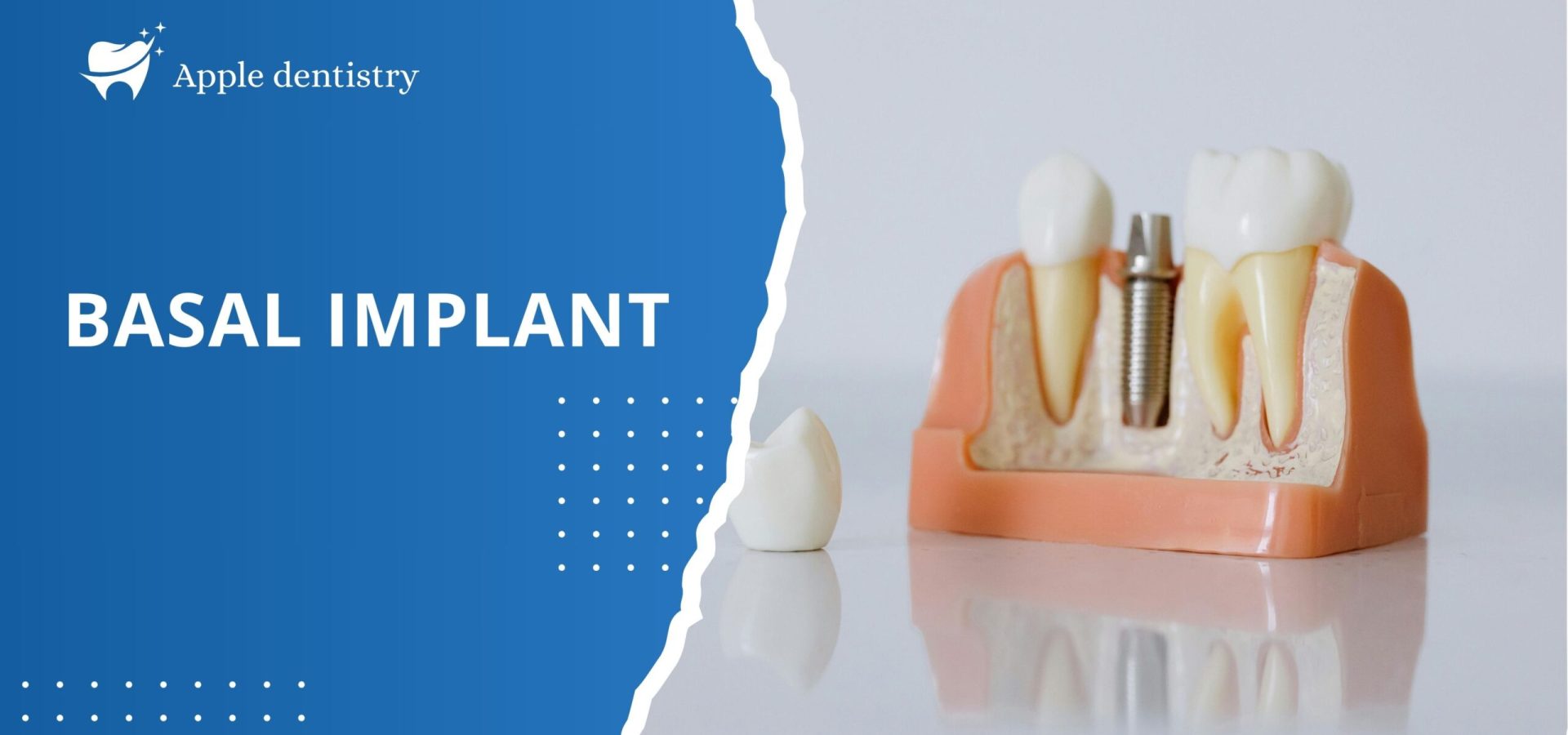 Basal Implants -banner