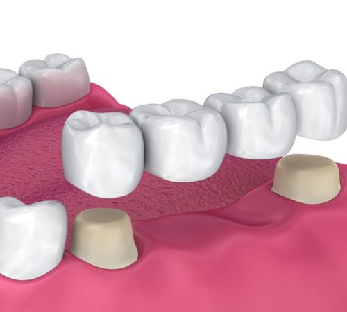 Dental Crowns & Bridges 1