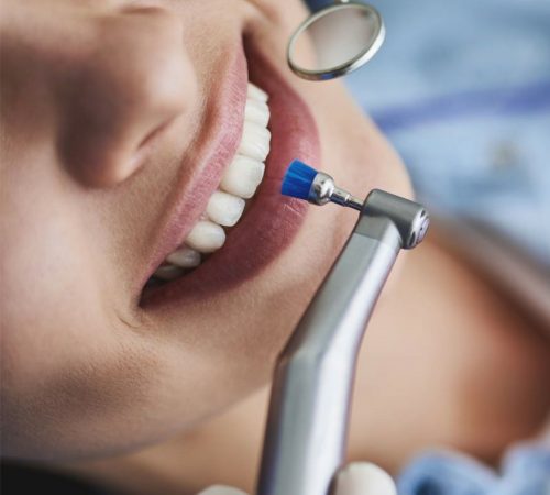 Teeth in an Hour 1